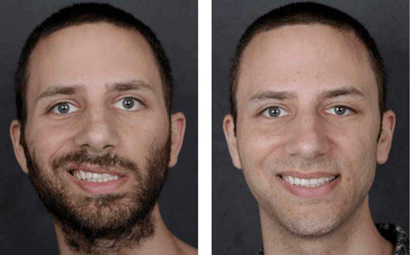 Patient with facial paralysis before and after treatment