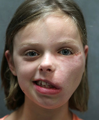 Treatment of longstanding facial palsy