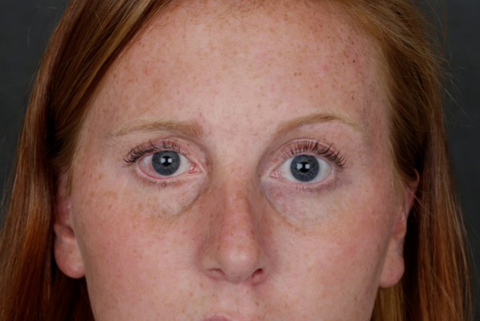 Mucosal graft to the lower eyelid to lift the lower eyelid