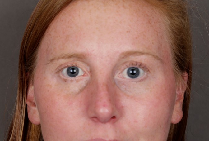 Mucosal graft to the lower eyelid to lift the lower eyelid
