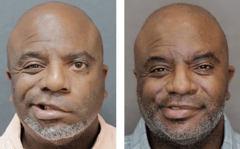 Photos of NYC man after facial paralysis surgery.
