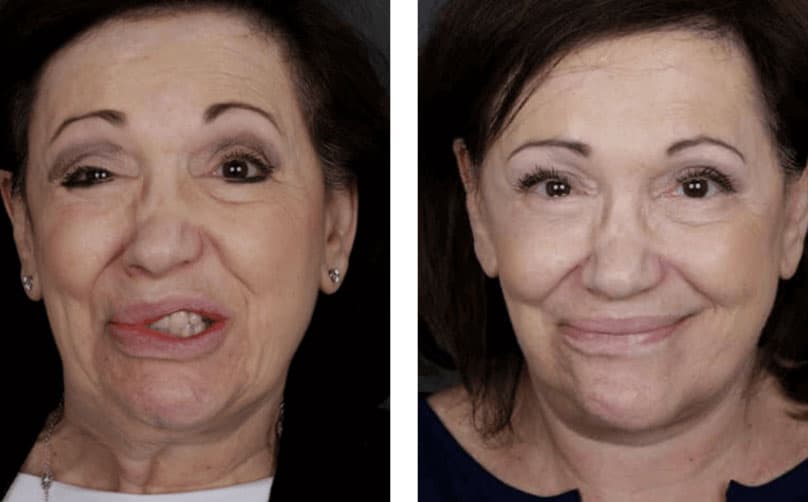 Before and after photo of woman after facial paralysis surgery in NYC.