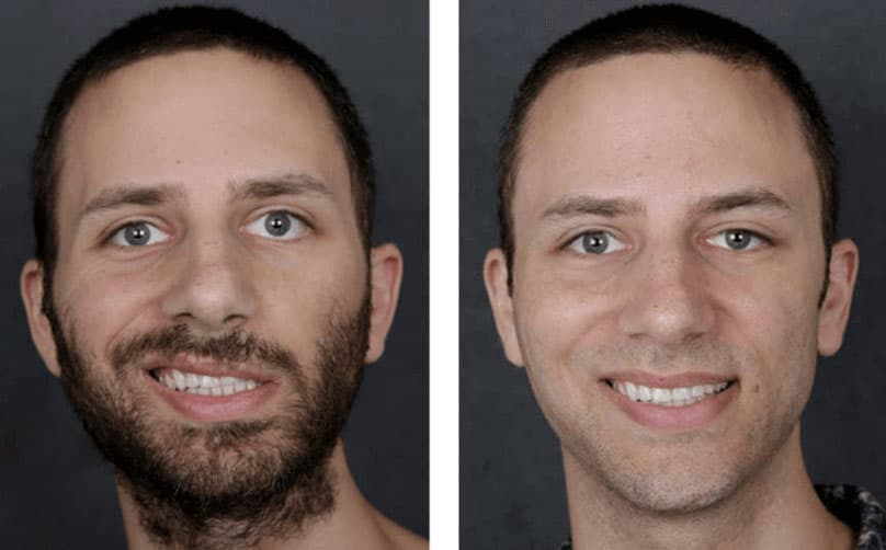Photo showing results from NYC facial paralysis surgery with New York Facial Paralysis center.